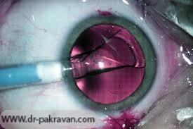 لنز مصنوعی ICL که از یک برش کوچک داخل چشم قرار داده می‎شود.